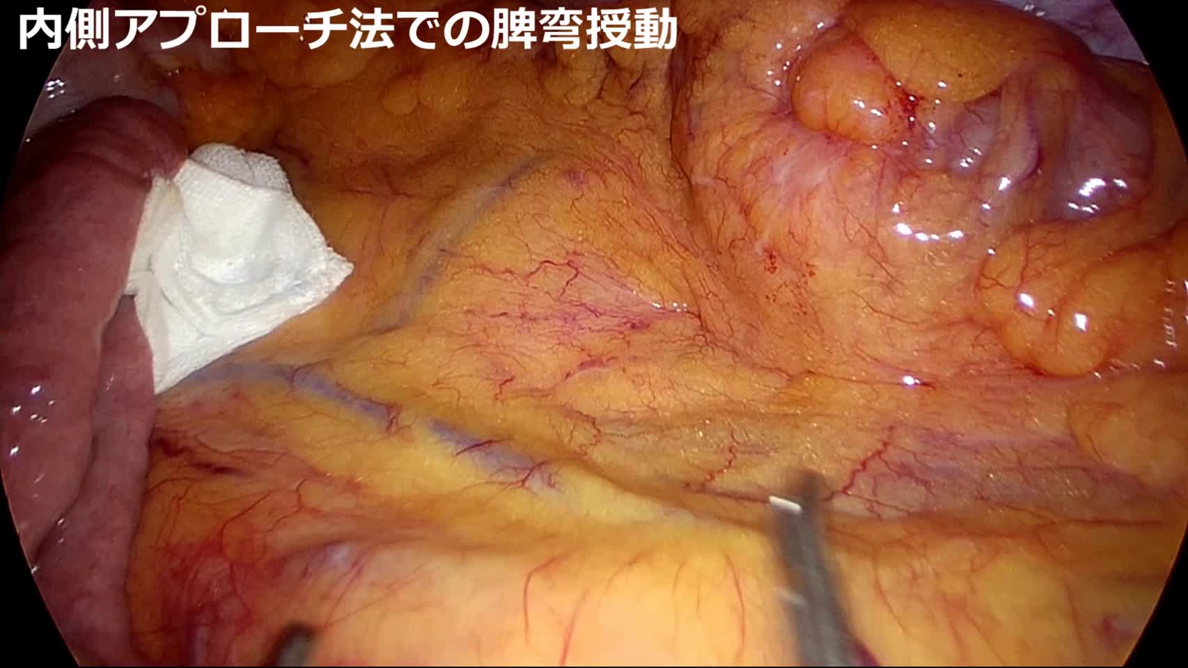 日鏡外会誌 28巻6号 video articles（足立論文）...