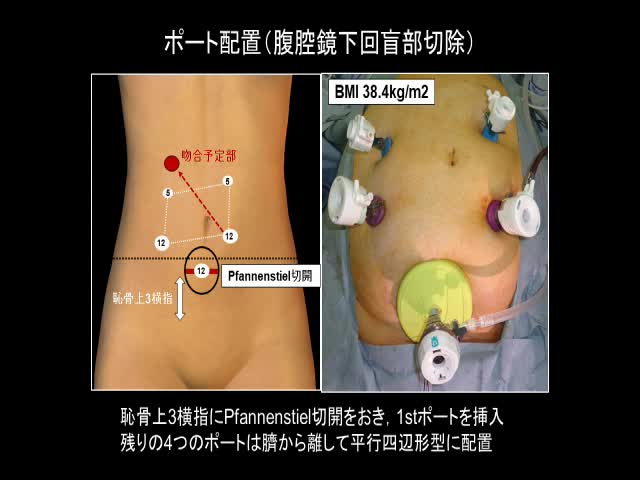 日鏡外会誌 30巻1号 手術手技（大渓論文）...