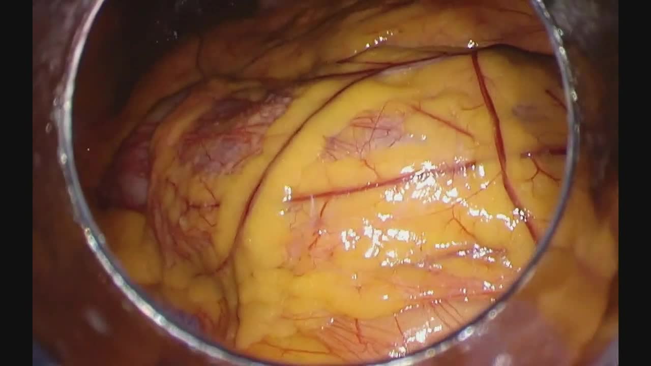 日鏡外会誌 31巻3号 症例報告（増木論文）...