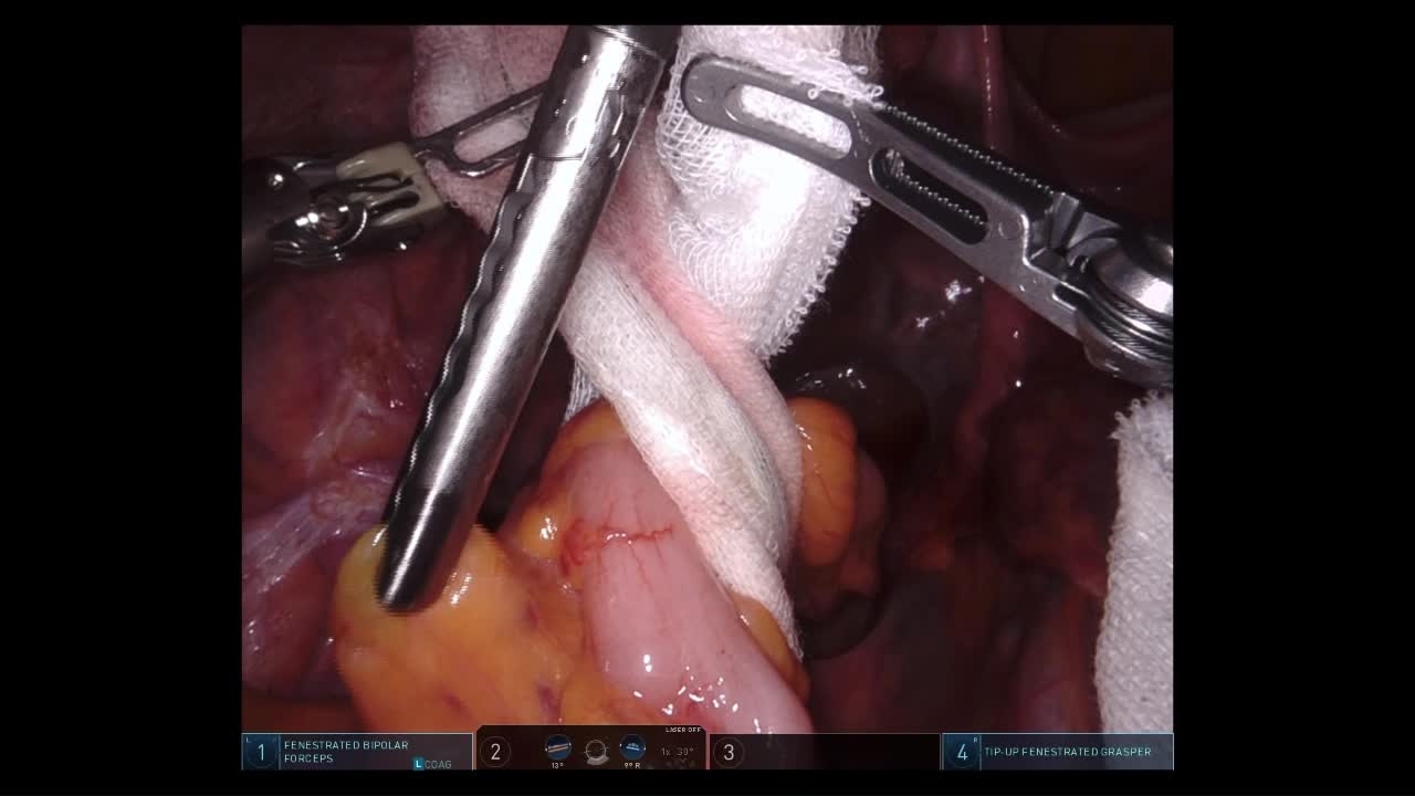日鏡外会誌 31巻4号 私の工夫（小坂論文）...